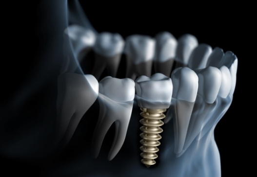 Animated smile after dental implant tooth replacement