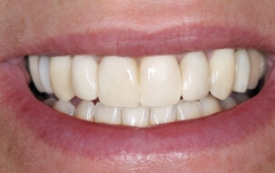 Healthy beautiful smile after cosmetic dentistry