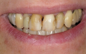 Damaged and decayed smile before cosmetic dentistry