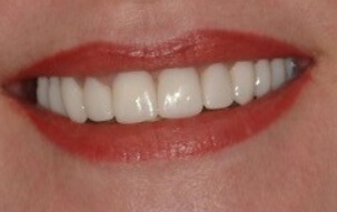 Smile after gaps between teeth were closed