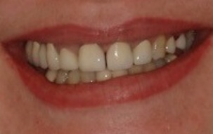 Smile with gaps between teeth