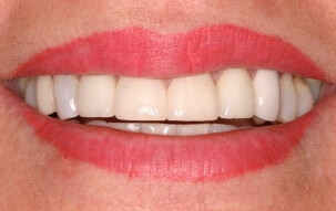 Smile after yellowed top tooth is brightened
