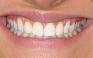 Bright white healthy smile after teeth whtiening