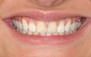 Darkly discolored top front teeth