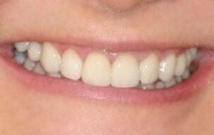 Evenly spaced and evenly sized teeth after cosmetic dentistry