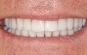 Bright smile after cosmetic dentistry