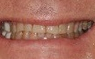 Yellowed teeth before cosmetic dentistry