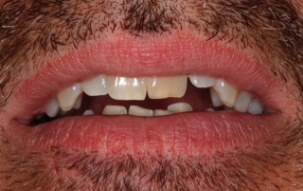 Crooked teeth before orthodontic treatment