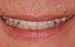 Smile with repaired top front teeth
