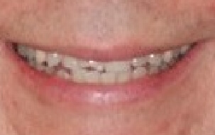 Smile with damaged top front teeth
