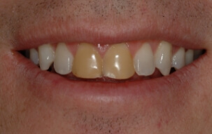 Yellowed top two front teeth