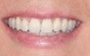Aligned smile after orthodontic treatment