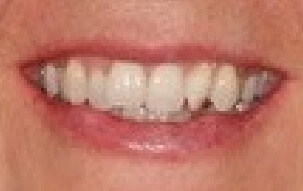 Misaligned smile before orthodontic treatment