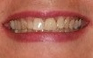 Discolored smile before teeth whitening