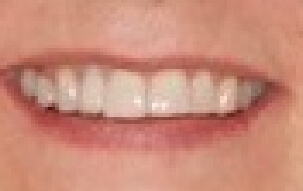 Smile with evenly sized front teeth