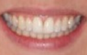 Brilliant smile after teeth whitening