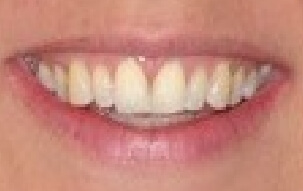 Yellowed smile before teeth whitening