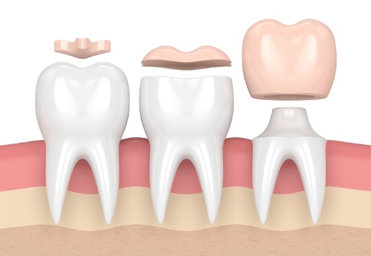 Three animated teeth showing different dental restorations in including dental crowns