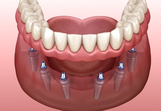 Animated smile during full mouth reconstruction