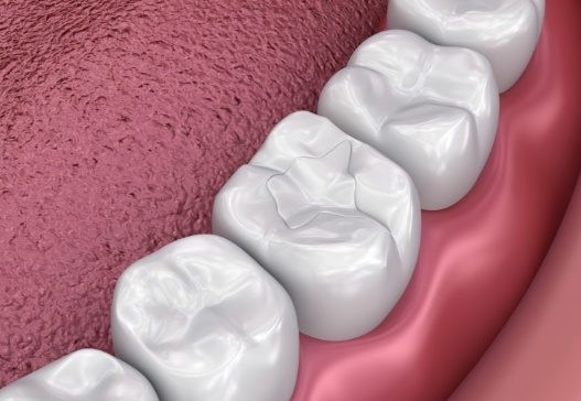 Animated smile with dental sealants