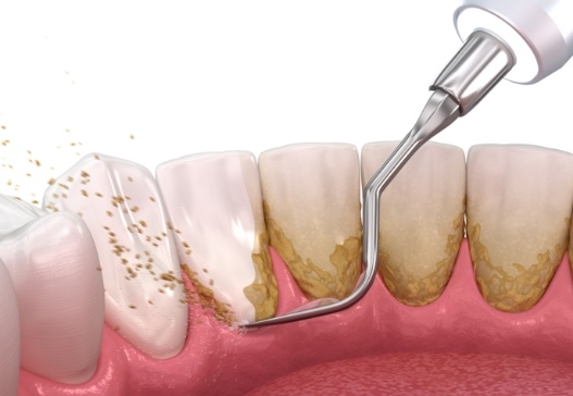 Animated smile during scaling and root planing treatment