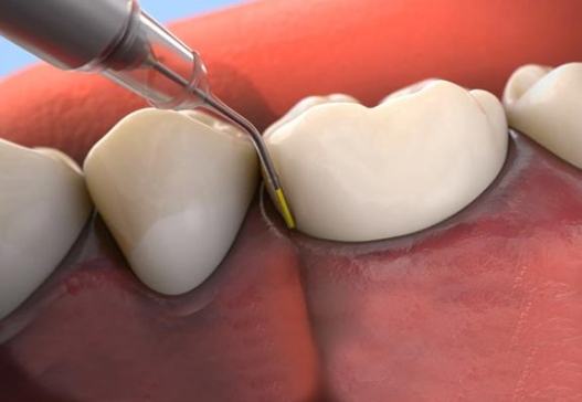 Animated smile during antibiotic therapy