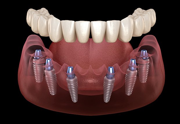 Illustration of implant dentures