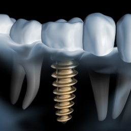 Animated dental implant supported dental crown