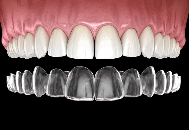 3D illustration of Invisalign in Warsaw