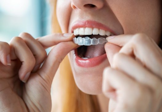 Closeup of dental patient placing an Invisalign clear aligner tray