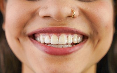 Closeup of smiling woman wearing Invisalign aligners