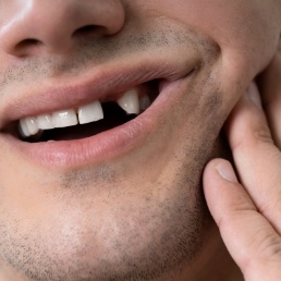 Closeup of smile with lost tooth before replacing missing teeth