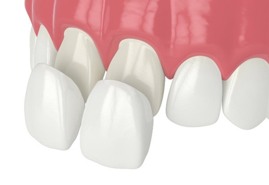 A 3D illustration of veneers in Warsaw being applied to teeth