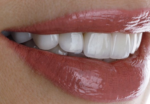 : A smile with porcelain veneers from Warsaw