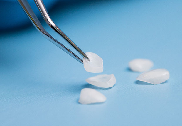 A dentist holding veneers in Warsaw with tweezers