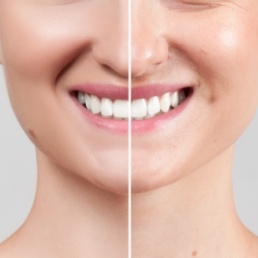 Woman with bright smile after teeth whitening