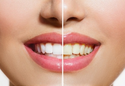 Closeup of smile before and after teeth whitening