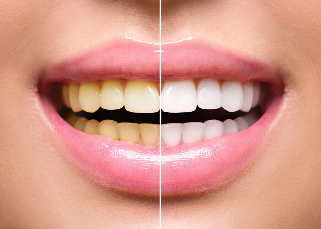 Closeup of a smile that's halved to show before/after teeth whitening